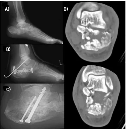 Figure  2.  Radiographs  showed  41  year  old  male  patient  with  intra-articular  calcaneus  fracture.