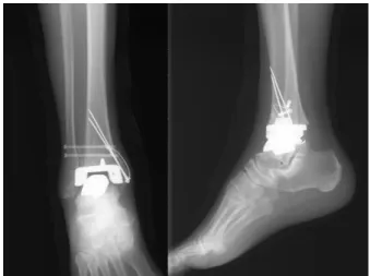 Table  2.  Complication Agility ®  type Hintegra ® type Prosthetic loosening -  