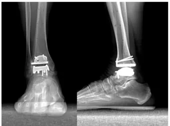 Figure  3.  The  radiograph  shows  AP  and  lateral  view  of  Hintegra  prosthesis  at  1-year  follow  up  in  a  52-year-old  man.