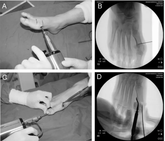 Figure  2.  The  metatarsal  osteotomy  is  preformed  using  a  standard  oscillating  saw  (A,  B)