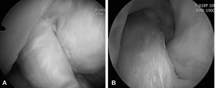 Fig. 4. (A) 26 years old man, who had ACL reconstruction using auto-hamstring tendon, with recent re-injury had undergone second look arthroscopy at 1 year postop