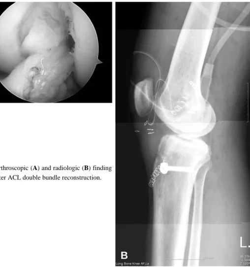 Fig. 3. Arthroscopic (A) and radiologic (B) finding after ACL double bundle reconstruction.