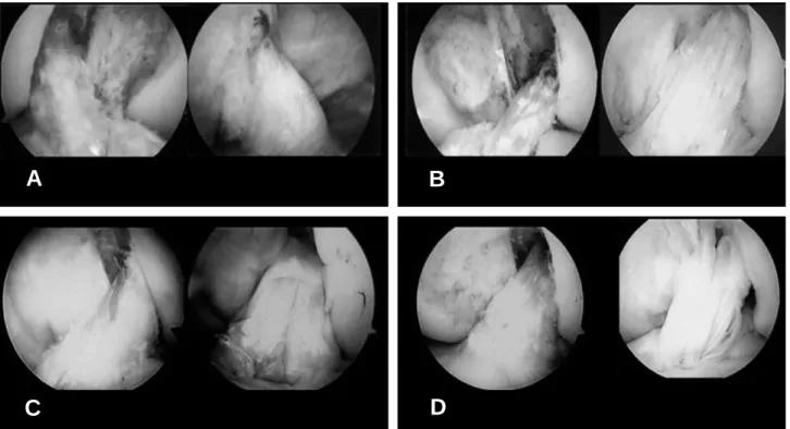 Fig. 1. The arthroscopic classification of grafts based on the synovial coverage. (A) more than 75%, (B) between 50% and 75%, (C) between 25% and 50%, (D) less than 25%.