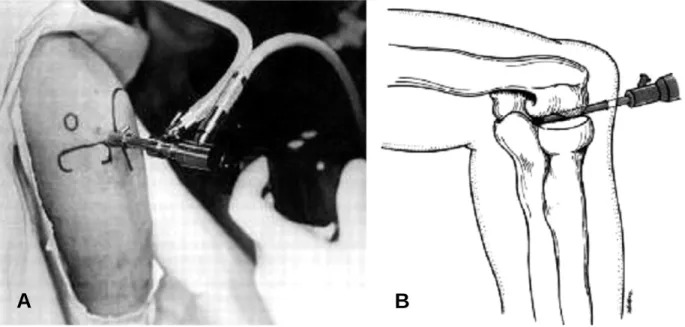 Fig 3. Transarticular portal.