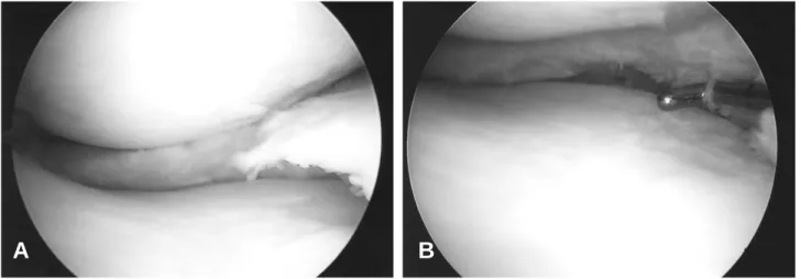 Fig. 4. (A,B) Nonabsorbable sutures were found out of the joint capsule when the preoperative scar on medial side of the knee was dissected