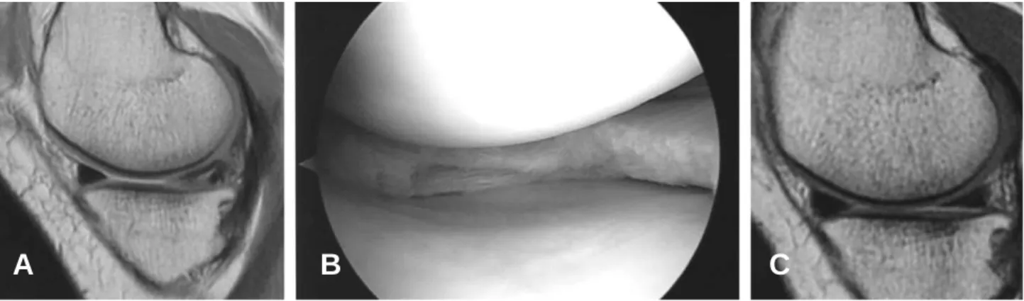 Fig. 5. A case that showed a well-healed medial meniscus after partial meniscectomy of horizontal tear