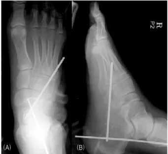 Figure  2.  (A)  Anteroposterior  and  (B)  oblique  radiograph  show  immediate  temporary  fixation  with  Steinman-pin.