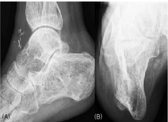 Figure  4.  (A)  Lateral  and  (B)  axial  radiograph  which  are  taken  15  months  later  the  injury,  show  a  good  alignment  and  bone  healing  after  hardware  removal