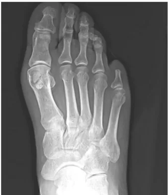 Figure  3.  Postoperative  plain  radiograph  of  the  right  foot  shows  amputation  state  of  the  5th  toe  at  proximal  phalanx  with  no  other  gross  bony  abnormality.