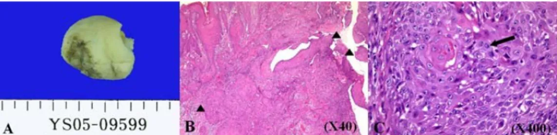 Figure  4.  Pathology;  (A)  The  ventral  surface  shows  an  ulcerated  gray  white  lesion