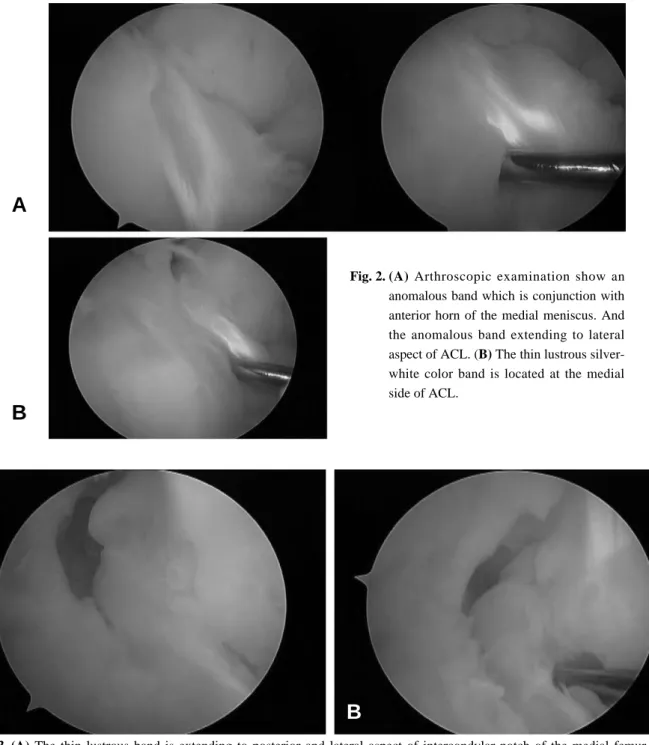 Fig. 2. (A) Arthroscopic examination show an anomalous band which is conjunction with anterior horn of the medial meniscus