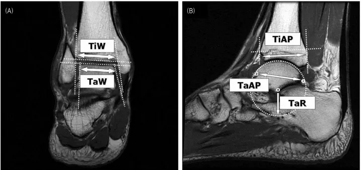 Figure  1.  Measurement  of  ankle  morphometry.  (A)  In  the  coronal  image,  the  tibial  width  (TiW)  is  the  distance  of  the  two  intersections  of  the  two  lines  that  are  drawn  fitting  the  internal  profiles  of  the  two  malleoli  and