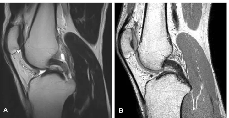 Fig. 1. The method of measuring the degree of continuity (thickness) of the injured posterior cruciate ligament in MRI;  ‘1’= intact portion, ‘2’= injured portion