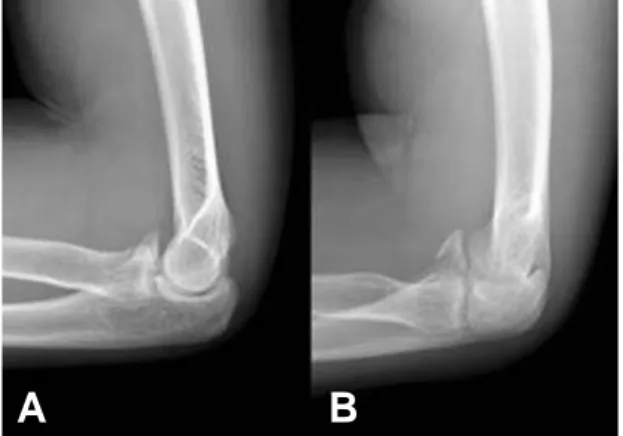 Fig. 4. Lateral (A) and coronoid view (B) of the elbow joint after open reduction and screw fixation of the  coro-noid fracture