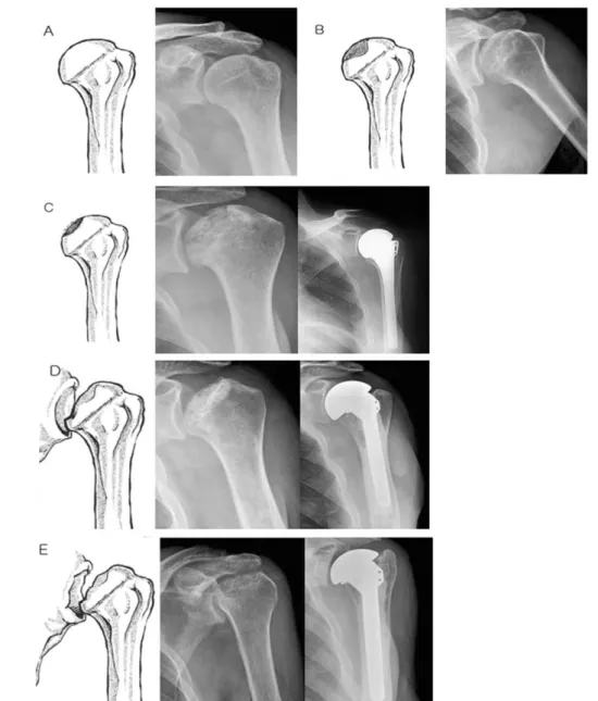 Fig. 2. Cruess classification is modified from Ficat &amp; Arlet classification of femoral head osteonecrosis