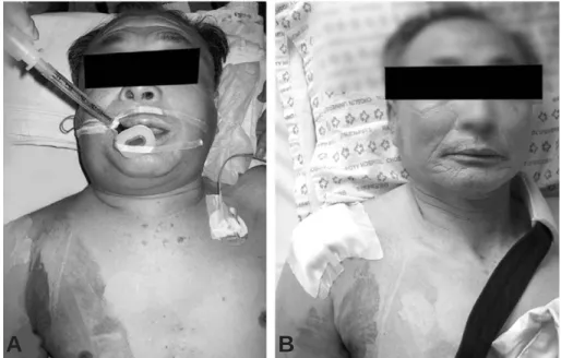 Fig. 1. The shoulder, neck and face are swollen and tense immediate after arthroscopic rotator cuff repair (A), forty- forty-eight hours after the surgery it reveal relieved (B).