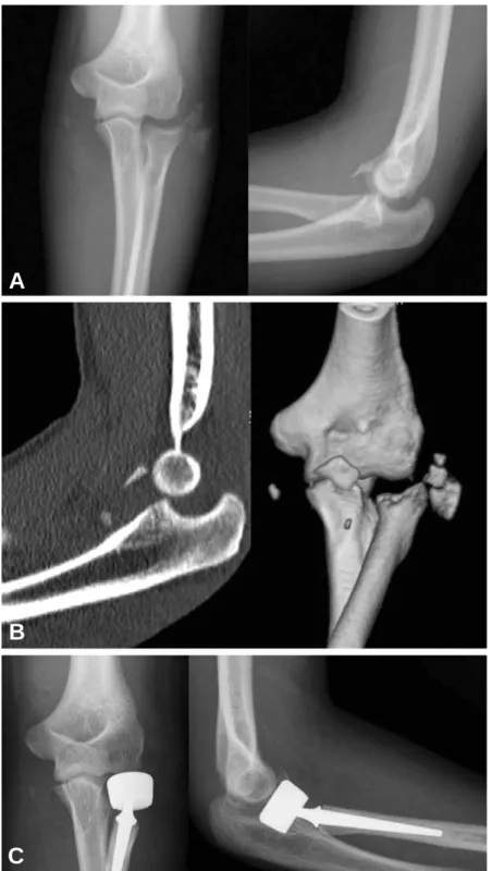 Fig. 2. (A) Radiographs of a 27-year-old man who fell from a height showing a terrible triad