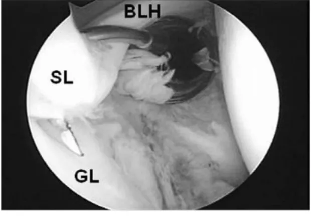 Fig. 4. The anchor loop (white suture material) is seated between the feet of the bio-knotless anchor (dark arrow) and the anchor is ready to be inserted into