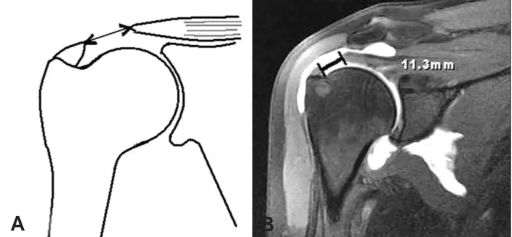 Fig. 1. (A) The scheme shows the measurement of the length of rotator-cuff tear in oblique coronal view of the MRA.