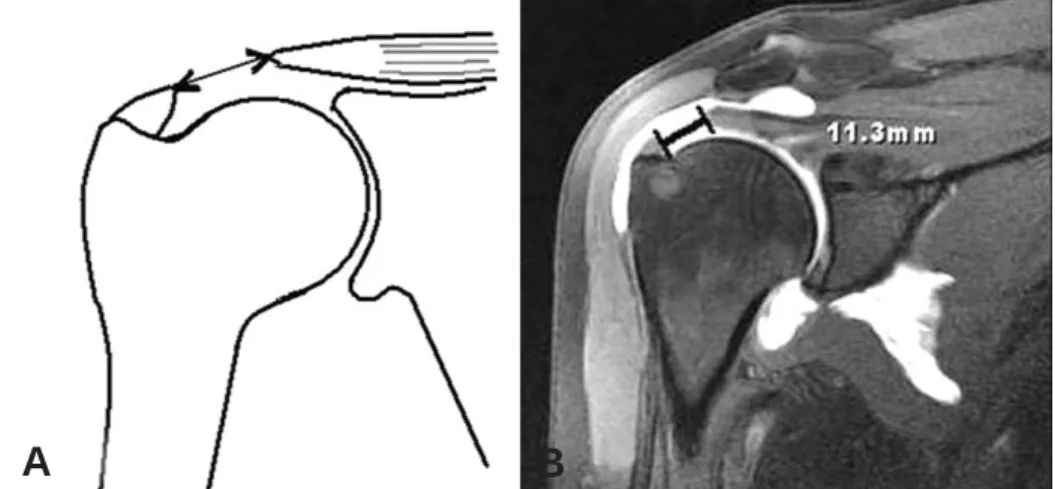 Fig. 1. (A) The scheme shows the measurement of the length of rotator-cuff tear in oblique coronal view of the MRA.