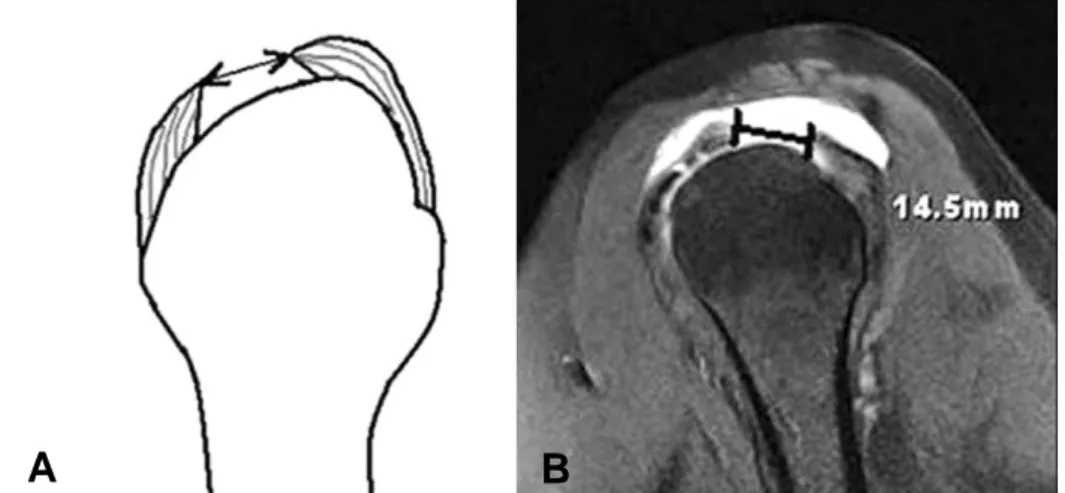 Fig. 3. (A) The rotator-cuff thickness was measured at the point where a line drawn from the tip of the acromion per- per-pendicular to the surface of the proximal portion of the cuff