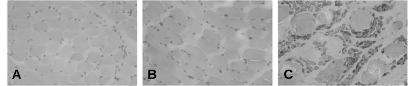 Fig. 3. The immunochemical staining of N-CAM protein (×20). (A) Negative reaction was noted in patient 1, a con- con-trol group
