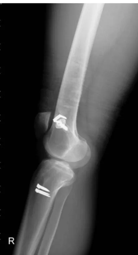Fig. 1. Plain lateral radiograph reveals a screw and a staple fixation in femur, two staples in tibia.