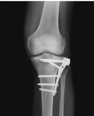 Fig. 2. Closeup photograph of submeniscal approach showed comminuted lateral tibial plateau  frac-ture under elevated lateral meniscus.