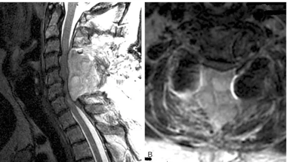 Fig. 2. Sagittal MRI showing large hematoma compressing the spinal cord from C3-T1.