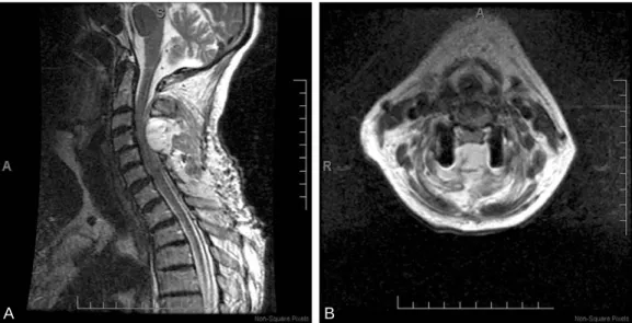 Fig. 3. (A) Sagittal MRI showing large hematoma compressing the spinal cord from C4-5