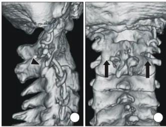 Fig. 4. CT-based simulation software shows the trajectory of the left C3 pedicle screw in two- and three-dimensional views.
