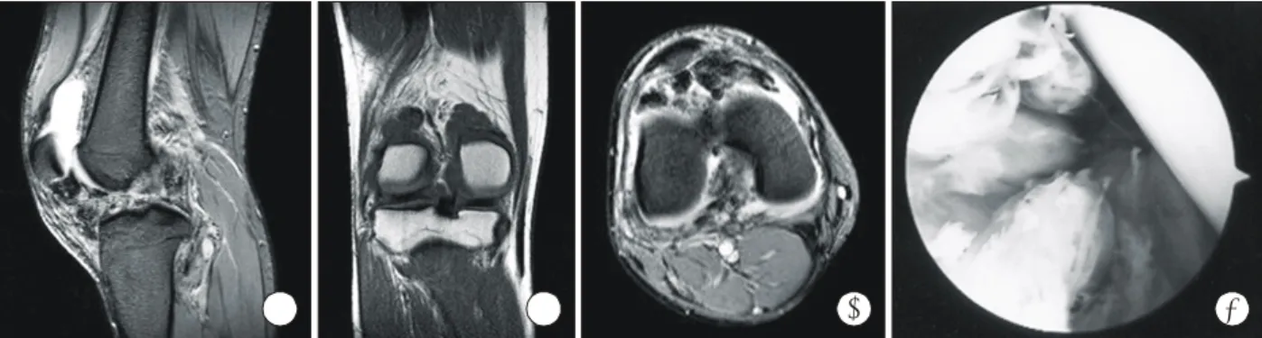Fig. 1. MRI and arthroscopic findings show the diffuse form of pigmented villonodular synovitis of the knee (A, sagittal T2-weighted; B,  coronal T2-weighted; C, axial T2-weighted; D, arthroscopic finding).