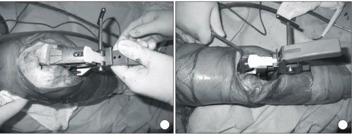 Fig. 3. Balancer/tensor device used in this study (Stryker How- How-medica Osteonics Ⓡ , Allendale, NJ, USA), which is composed of  a body  plate with two paddles and a slide rule sizer.