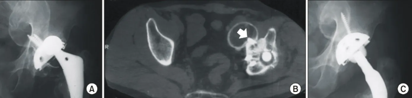 Fig. 1. (A) A huge calcified mass is seen in the medial side of the pelvis in a failed total hip arthroplasty