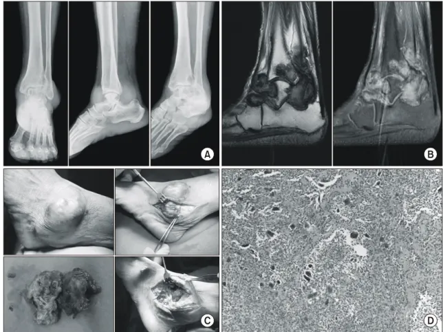 Fig. 2. (A)  Preoperative  standard  left  ankle  radiographs  show  a  diffuse  soft  tissue  mass  and  lytic  lesions  of  the  distal  tibiofibular  joint, talus,  calcaneus  and  talonavicular  joint