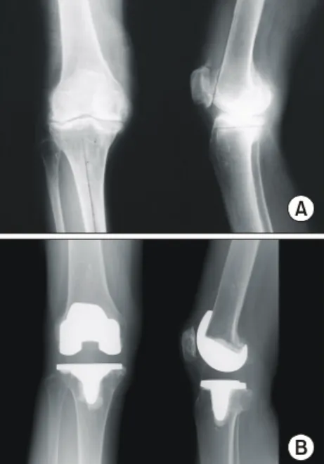Fig. 2. 67-year-old-female  patient  with  osteoarthritis  who  was  treated with PFC  Ʃ RP  PS total  of the knee arthroplasty