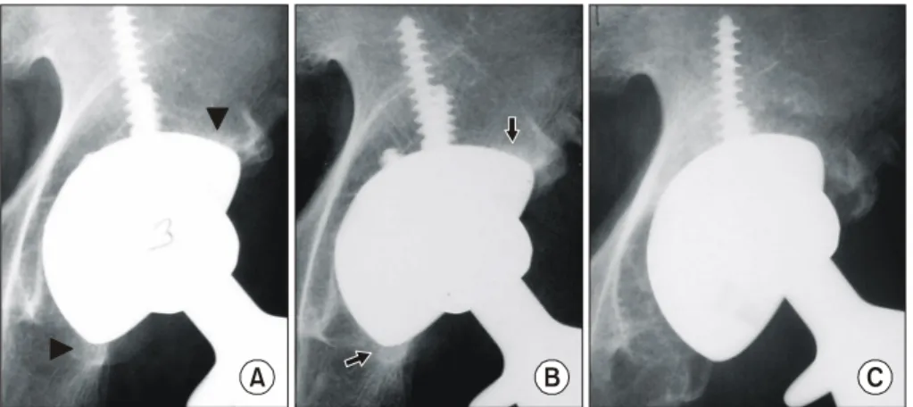 Fig. 1. Serial radiographs demon- demon-strate  loosening  of  the  acetabular  component