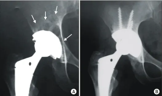 Fig. 1.  (A)  Anteroposterior  ra- ra-diograph  of  the  right  hip  of  a  24-year-old woman,  96 months after  the  total  hip  arthroplasty  showed  diffuse expansile pelvic osteolysis  in  all  three  zones  (arrows)  with  eccentric   polye-thylene  w