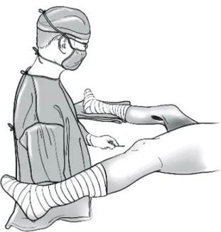 Fig. 2. The  operation  table  was  tilted  30  degrees  so  that  the operated  knee  was  lower  than  the  contralateral  knee  for  the  posterior  approach  and  the  operator  is  located  between  the  patient's  lower  extremities.