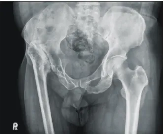 Fig. 1. X-ray shows hypoplastic femur and flat acetabulum com- com-bined  with  degenerative  changes.