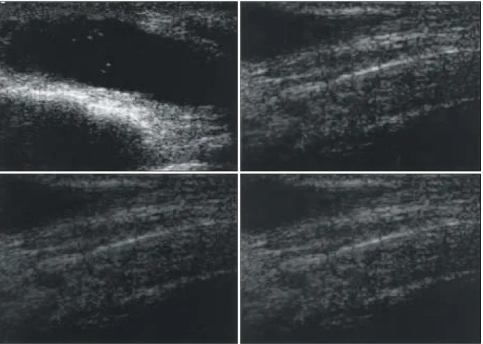 Fig. 1.  Sonographic  image  demonstrates  a  relatively  well-defined  low  echoic  mass  within  the  extensor  hallucis  brevis  sheath  along  the course  of  the  tendon.