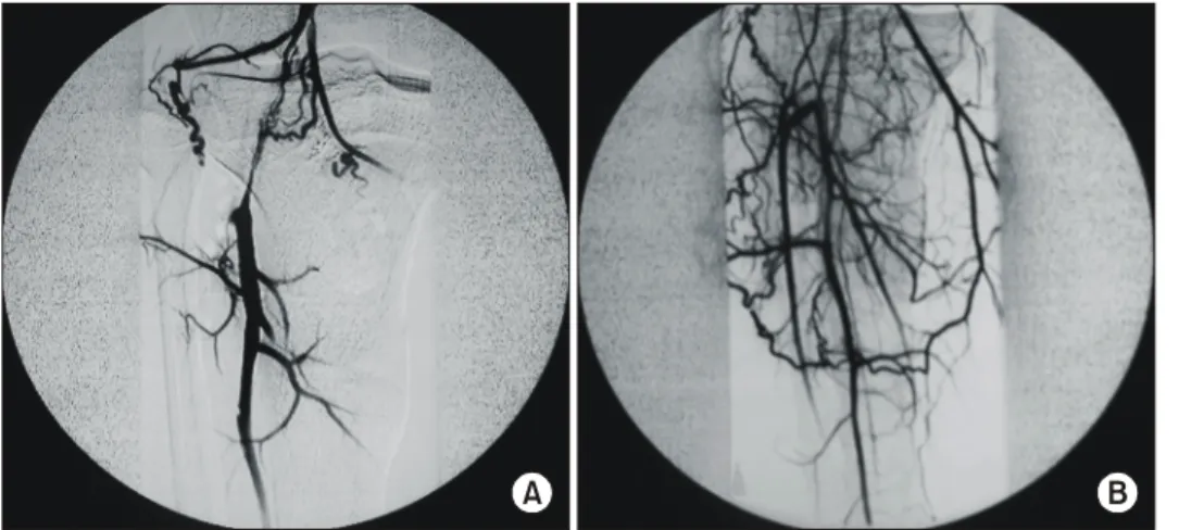 Fig. 3. (A) Angiogram (case 5) showing  an  occlusion  of  the  popliteal  artery  6  months  after  the  corrective  osteotomy