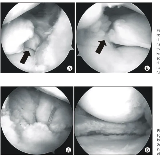 Fig. 4.  (A)  The  meniscal  root  ligament  was  sutured  by   ethi-bond  to  the  tibial  plateau