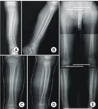Fig. 2. A  6-year old  boy  (case  number  11)  had  suffered  a tibial shaft fracture as a result of a traffic accident  (A,  B)