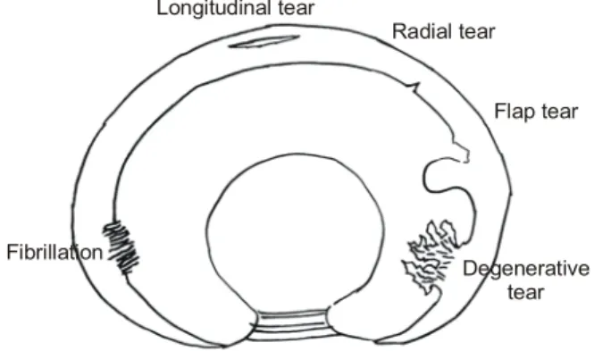 Fig. 1. Schematic  diagram  showing  various  types  of  acetabular labral  lesions. Longitudinal tear Radial tear Flap tear DegenerativetearFibrillation