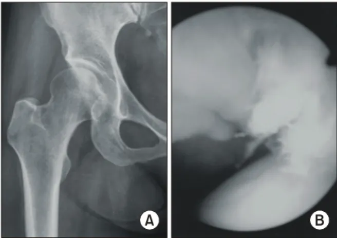 Fig. 2.  The  area  of  the  acetabulum  was  divided  into  5  zones (A,  anterior; AS, anterosuperior; S, superior; PS, posterosuperior;