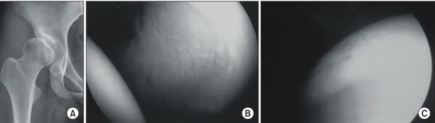 Table 4. Location  of  the  Chondral  Lesions  according  to  the  Arthroscopic  Findings