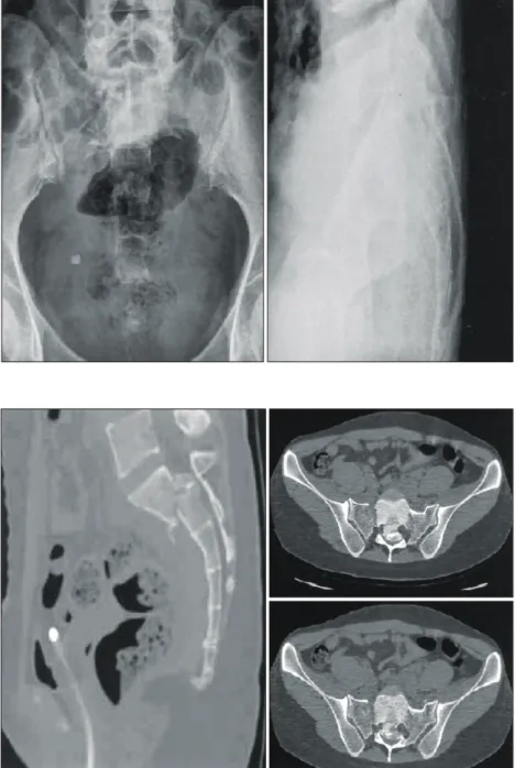 Fig. 2.  The  initial  CT  findings  shows  a  displaced  first  sacral  body  fracture.