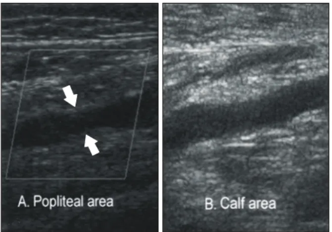 Table 1. Comparison of the diagnostic efficacy with MDCT and color  Doppler  sonography  in  detecting  DVT