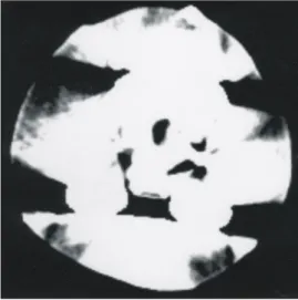Fig. 4. The interruption phenomenon at the popliteal area (distal cut  of  the  femoral  stem)  of  multidetect-row  computed   tomo-graphy  (MDCT).